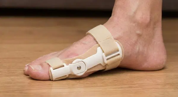 拇指外翻矯正器真的有用嗎？