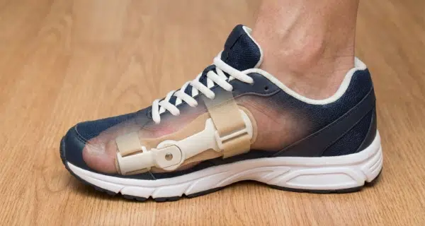 拇指外翻矯正器真的有用嗎？