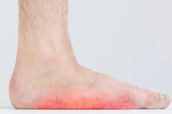 扁平足為何容易得到足底筋膜炎！