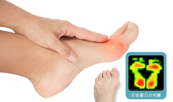 拇指外翻是鞋子穿出來的嗎？一次看懂真正可能原因